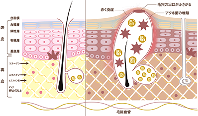 健康な肌とニキビの比較